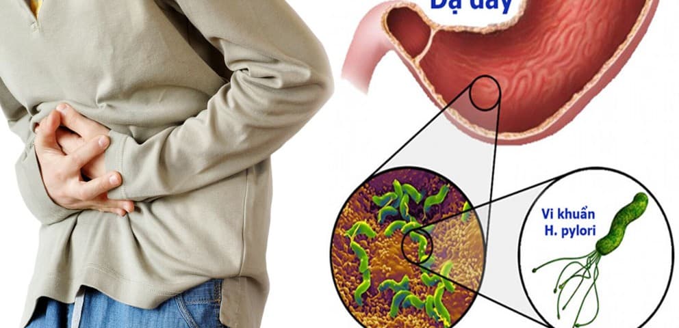 ORDER HÀNG HÀN QUỐC BIẾN CHỨNG NGUY HIỂM KHI NHIỄM VI KHUẨN HELICOBACTER PYLORI (HP)